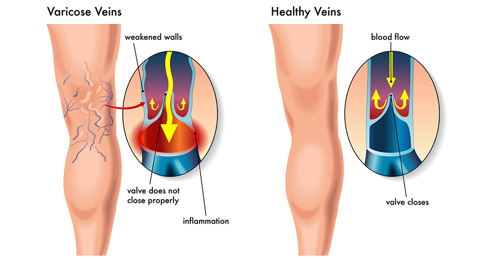 varicose veins