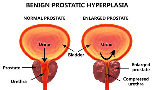 Benign prostatic hyperplasia